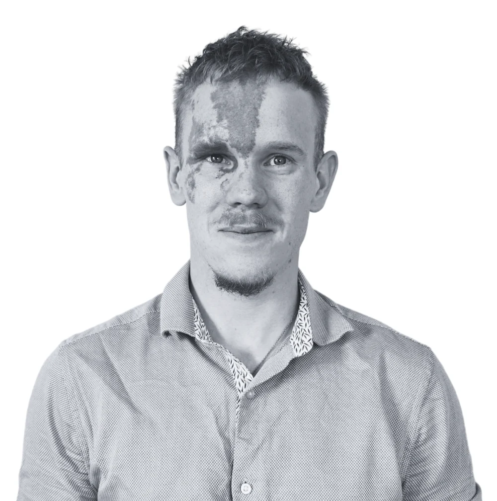 A black and white portrait of Ben, a man with a port-wine stain birthmark on the right side of his face.